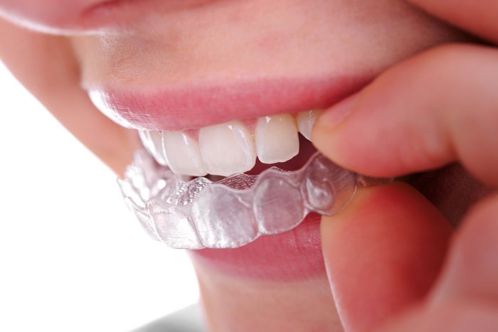 DrNigg-Kiefergelenksprobleme-Zahnschiene